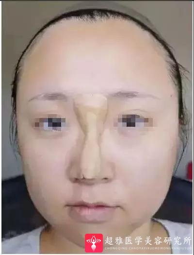 鼻综合整形术