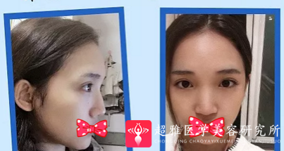 鼻综合整形术