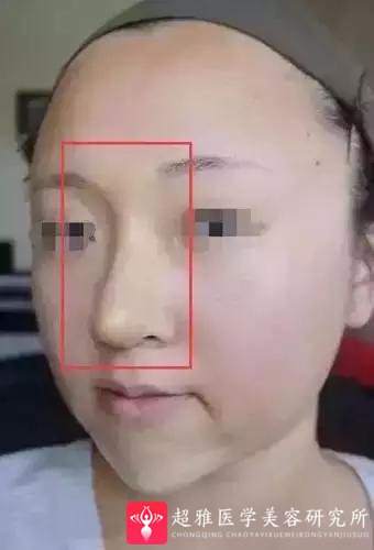 鼻综合整形术