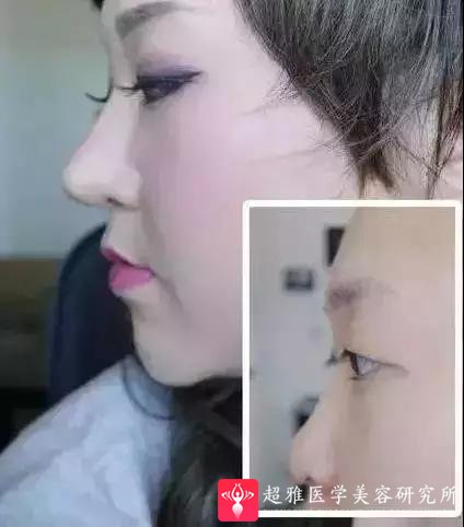 鼻综合整形术
