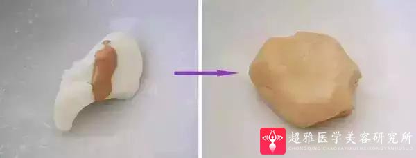 鼻综合整形术