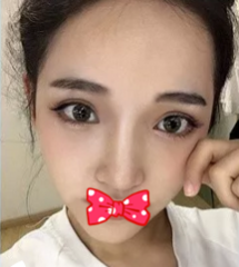 鼻综合整形术