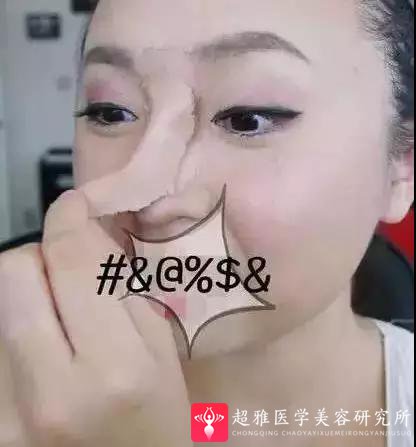 鼻综合整形术