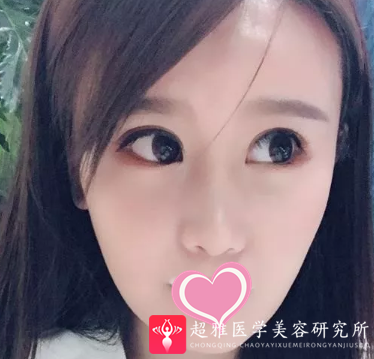 面部提升术