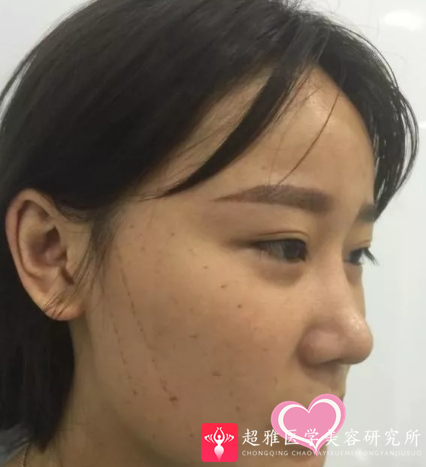 面部提升术