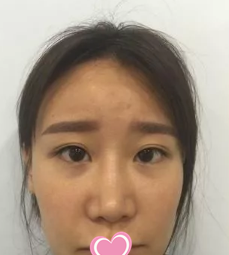 面部提升术