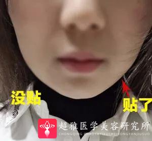瘦脸方法