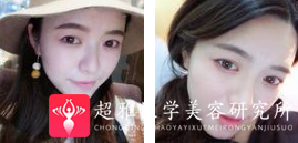 面部提升术