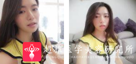 面部提升术