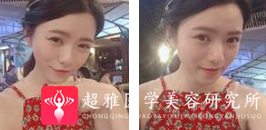 面部提升术