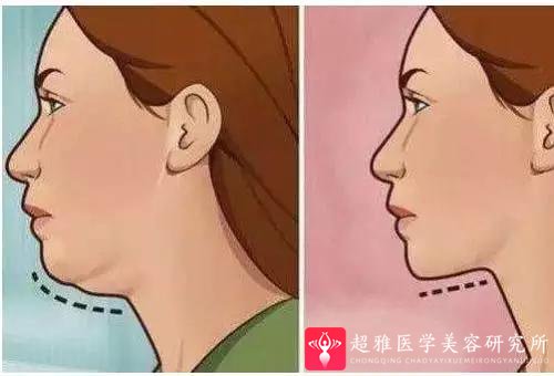 双下巴