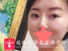 面部提升术