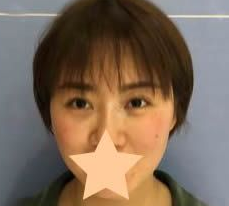 面部提升术
