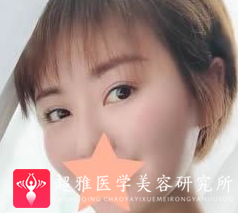 面部提升术