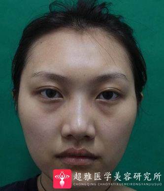 自体脂肪填充术