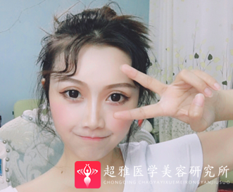 自体脂肪填充术