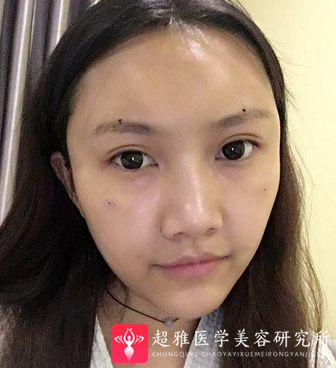 自体脂肪填充术