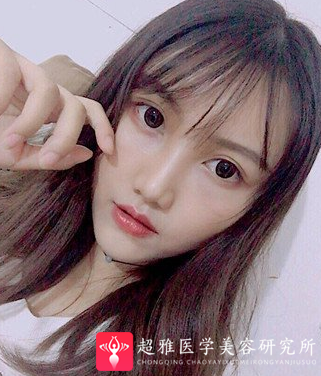 自体脂肪填充术