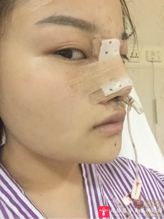 不开刀隆鼻