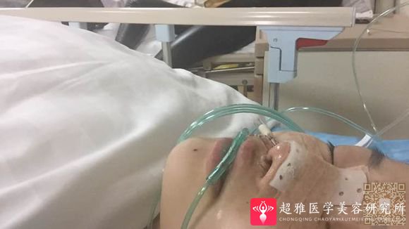 不开刀隆鼻