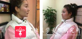 面部提升术