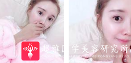 面部提升术