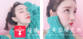 面部提升术