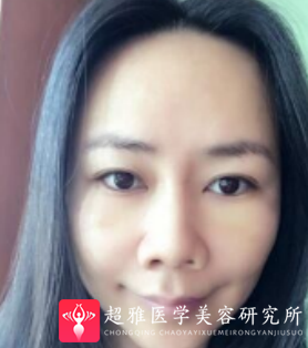 面部提升术