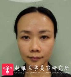 面部提升术