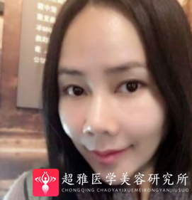 面部提升术