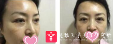 面部提升术