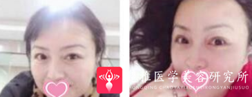 面部提升术
