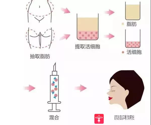 自体脂肪填充术