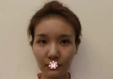 自体脂肪填充术