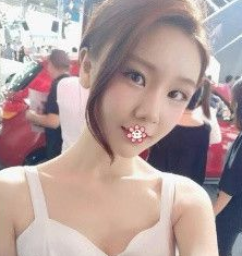 自体脂肪填充术