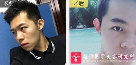 超声波瘦脸