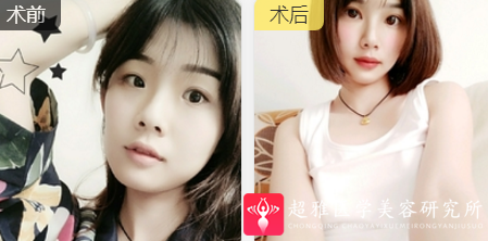 超声波瘦脸