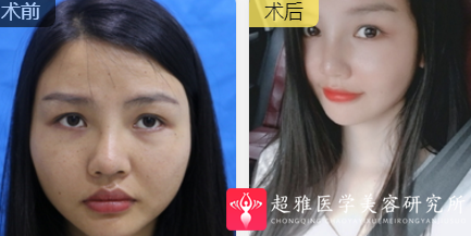 超声波瘦脸
