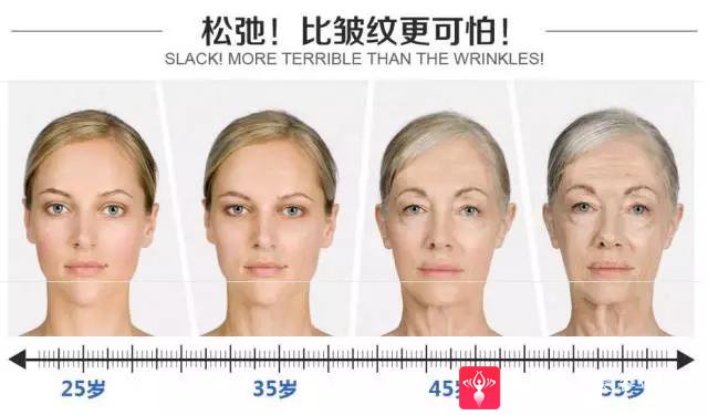 面部提升术