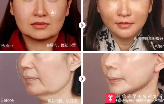 面部提升术