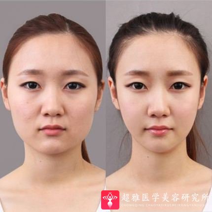 超声波瘦脸