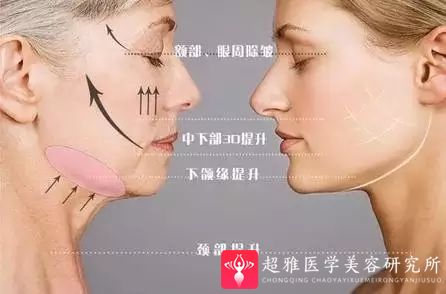 面部提升术