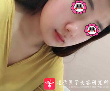 面部吸脂
