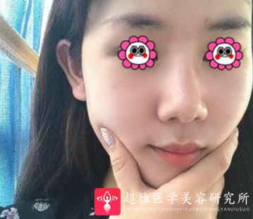 面部吸脂