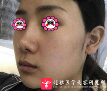 面部吸脂