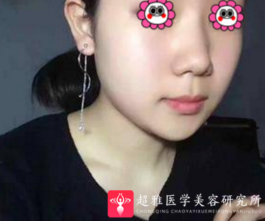面部吸脂