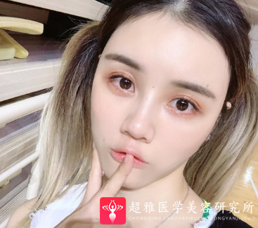 自体脂肪填充术