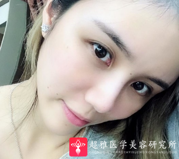自体脂肪填充术