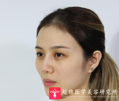自体脂肪填充术
