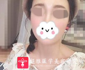 面部提升术